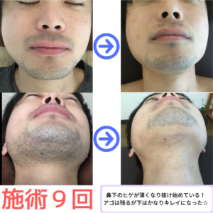メンズ　ヒゲ脱毛　９回