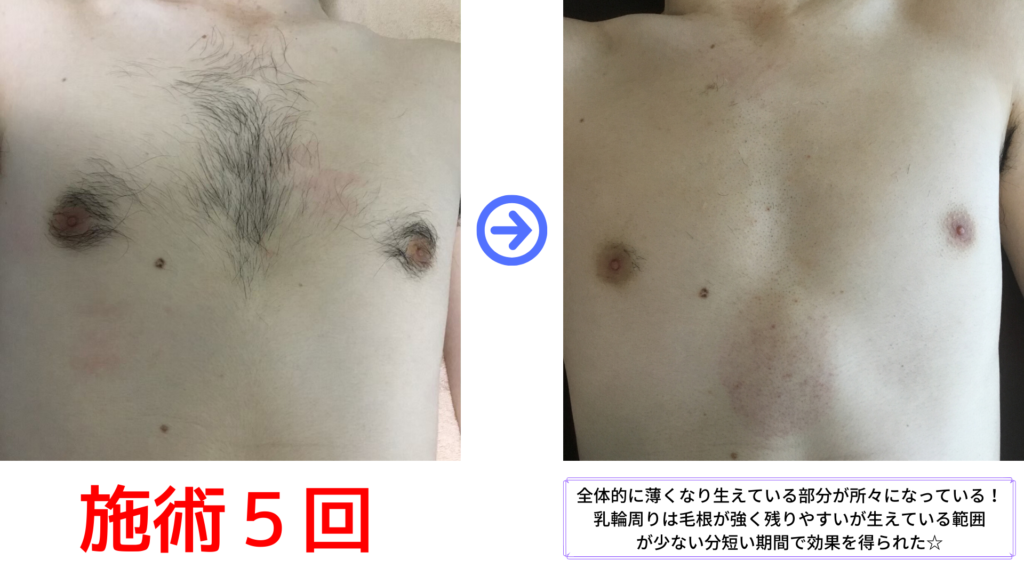 胸脱毛　施術５回