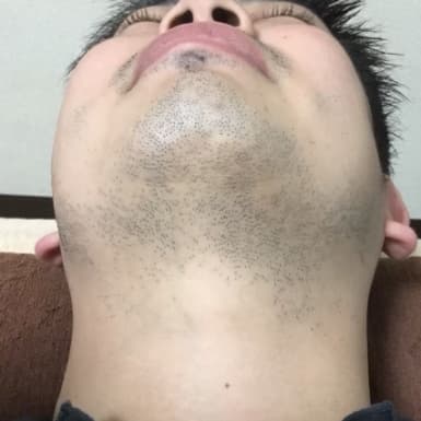 横浜のメンズ脱毛/完全都度払いで安い男性専用脱毛サロン
