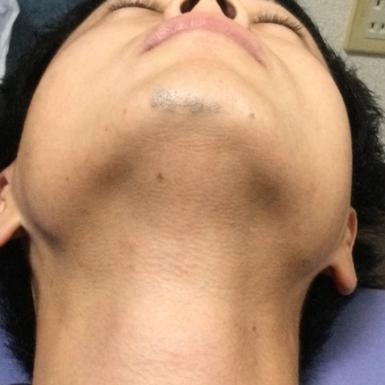 横浜のメンズ脱毛/完全都度払いで安い男性専用脱毛サロン