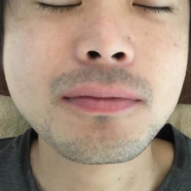 横浜のメンズ脱毛/完全都度払いで安い男性専用脱毛サロン