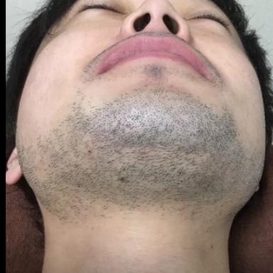 横浜のメンズ脱毛/完全都度払いで安い男性専用脱毛サロン