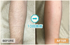 10回施術のビフォーアフター