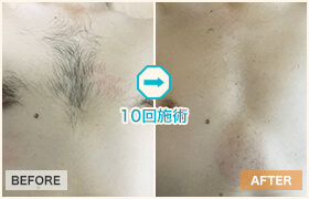 10回施術のビフォーアフター