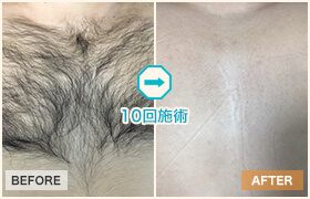 10回施術のビフォーアフター