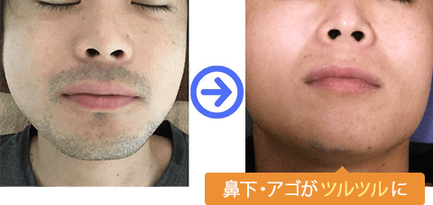 鼻下・アゴがツルツルに