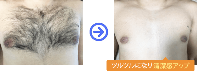 ツルツルになり清潔感アップ